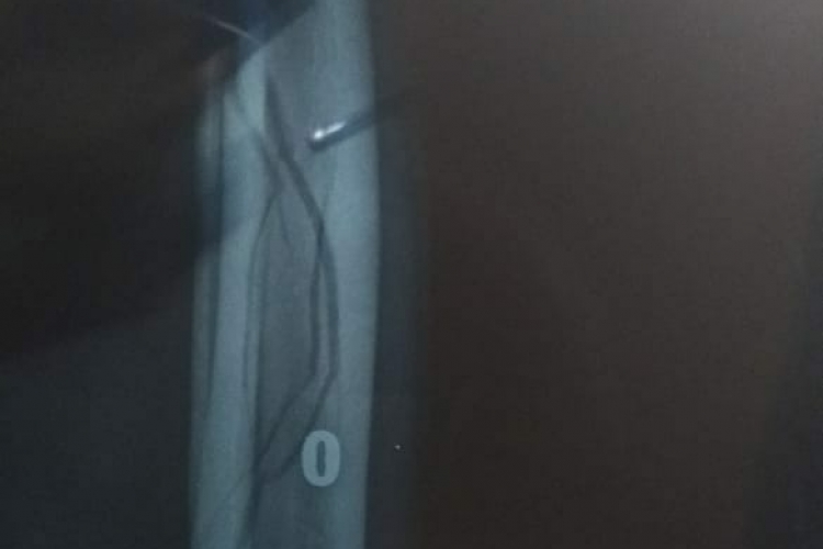 Hasil Rontgen Pertama 