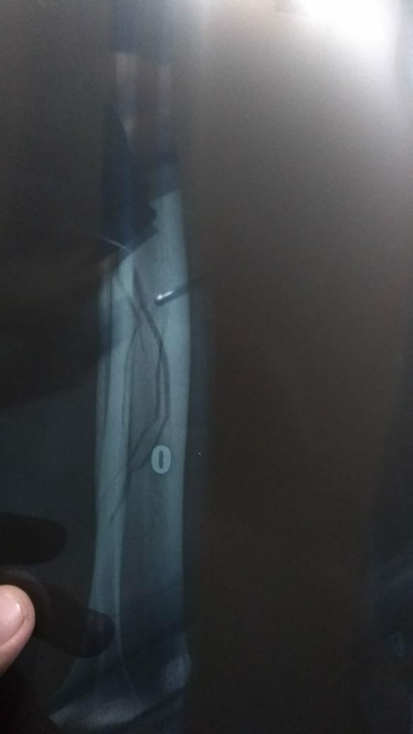 Hasil Rontgen Pertama 